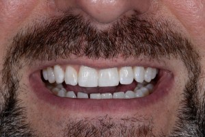 After Case E - Cosmetic Bonding - Dr. Daniel Aldieri