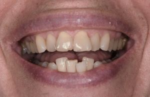 Before Case E - Cosmetic Bonding - Dr. Daniel Aldieri