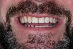 Before Case E - Cosmetic Bonding - Dr. Daniel Aldieri