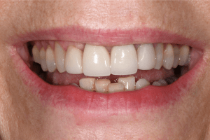 Before Zoom Whitening Case