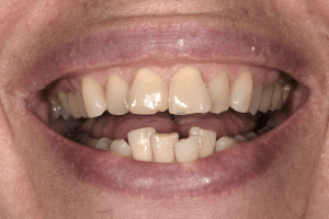 before whole mouth cosmetic reconstruction