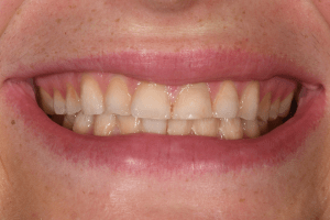 before whole mouth cosmetic reconstruction