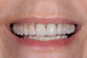 After Zoom Whitening Case
