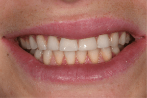 after whole mouth cosmetic reconstruction