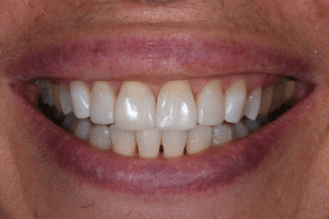 after whole mouth cosmetic reconstruction