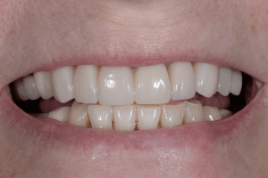 After Zoom Whitening Case
