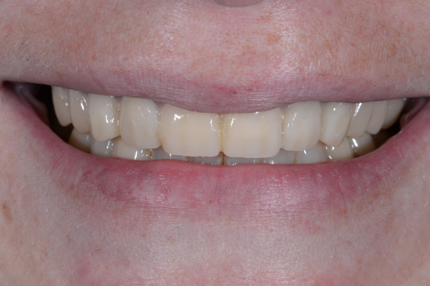 after whole mouth cosmetic reconstruction