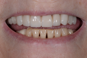 Before Zoom Whitening Case