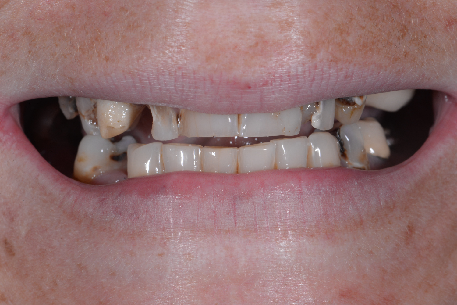before whole mouth cosmetic reconstruction