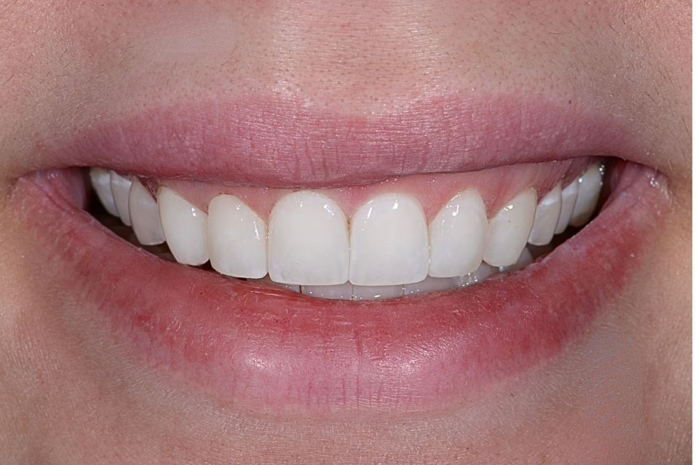 After Cosmetic Work