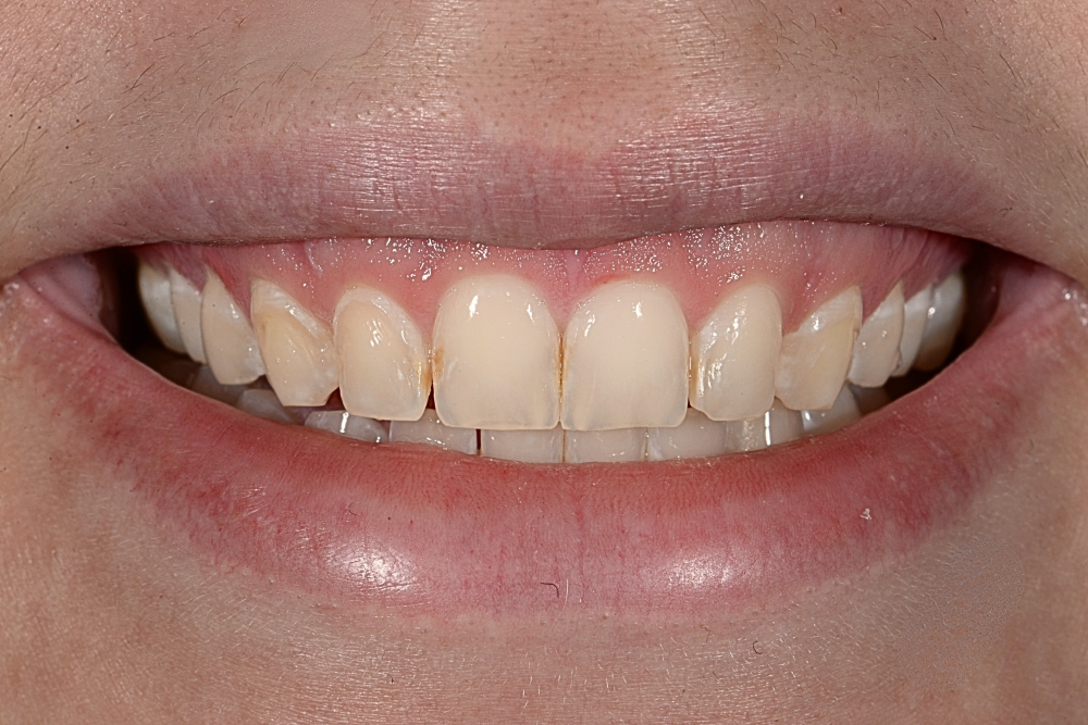 Before Cosmetic Work