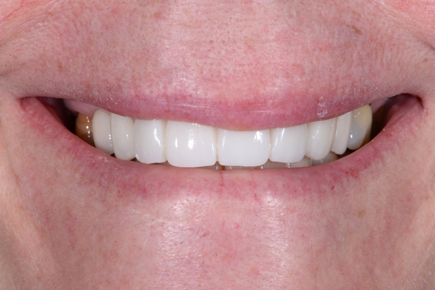 Dental Crowns