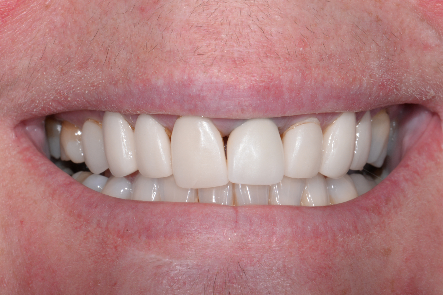 Dental Crowns
