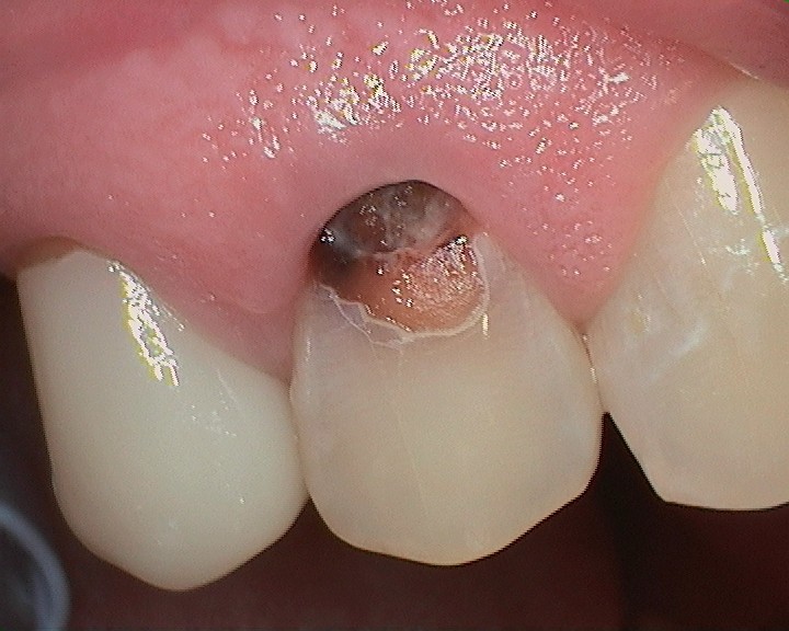 Composite Restorations Before Case A