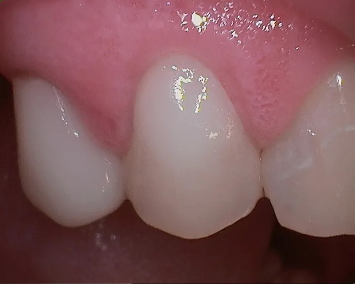 after composite restoration