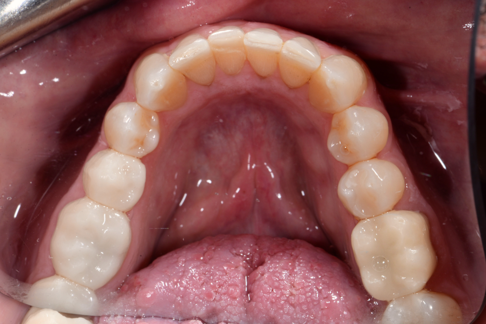 after smile makeover