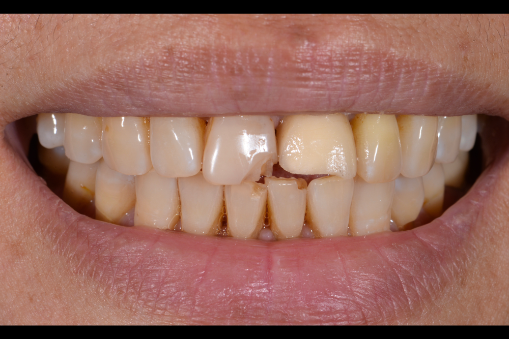before cracked tooth