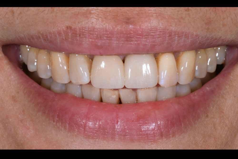 after cracked tooth
