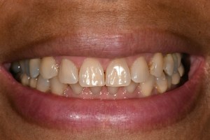 Before KOR whitening