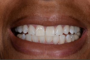 After KOR whitening