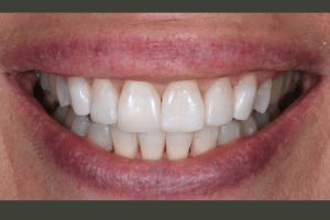 After photo consisting of Invisalign, KOR Whitening and Cosmetic Dental Bonding.